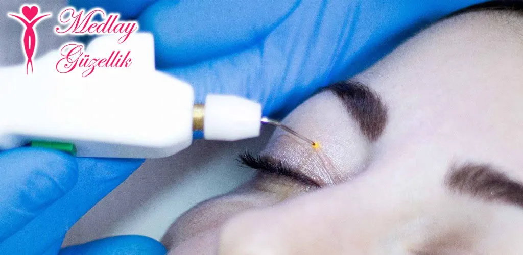 Tesisler Plexr Ameliyatsız Göz Kapağı Estetiği